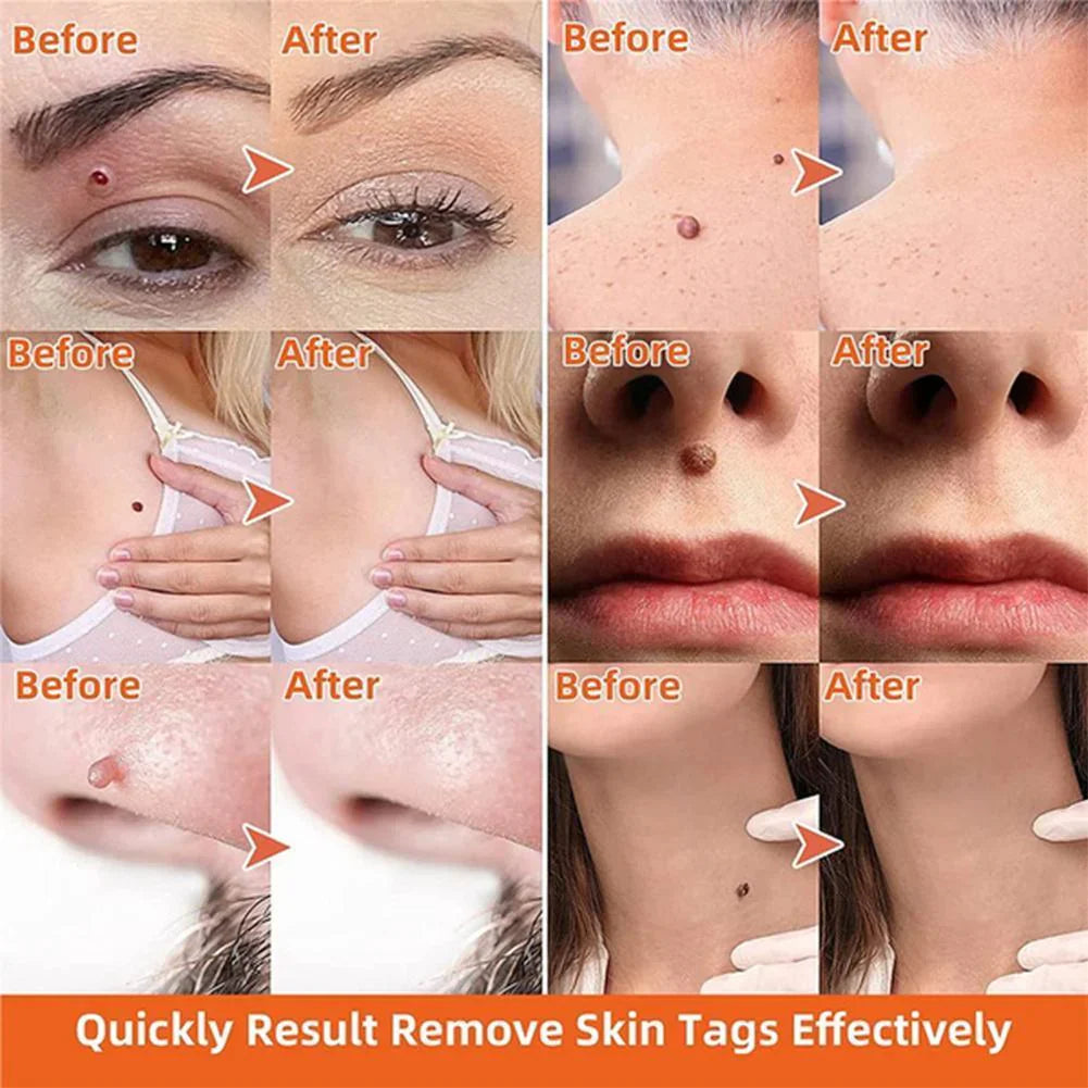 Skin Tag Removal Kit with Two Spring Sizes and 7-10 Day Process