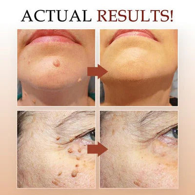 Topical Skin Tag Remover Solution with Tea Tree Oil and Arborvitae Extract