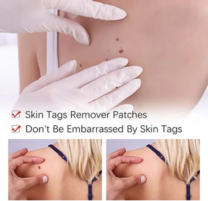 Topical Skin Tag Remover Solution with Tea Tree Oil and Arborvitae Extract